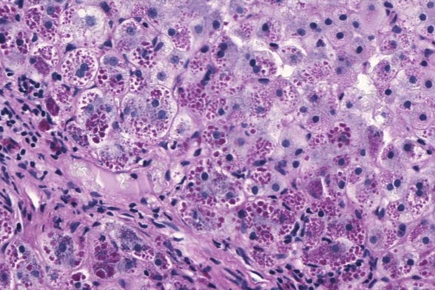 Photomicrograph of a liver biopsy from a patient with alpha-1 antitrypsin deficiency. The PAS with diastase stain shows the diastase-resistant pink globules that are characteristic