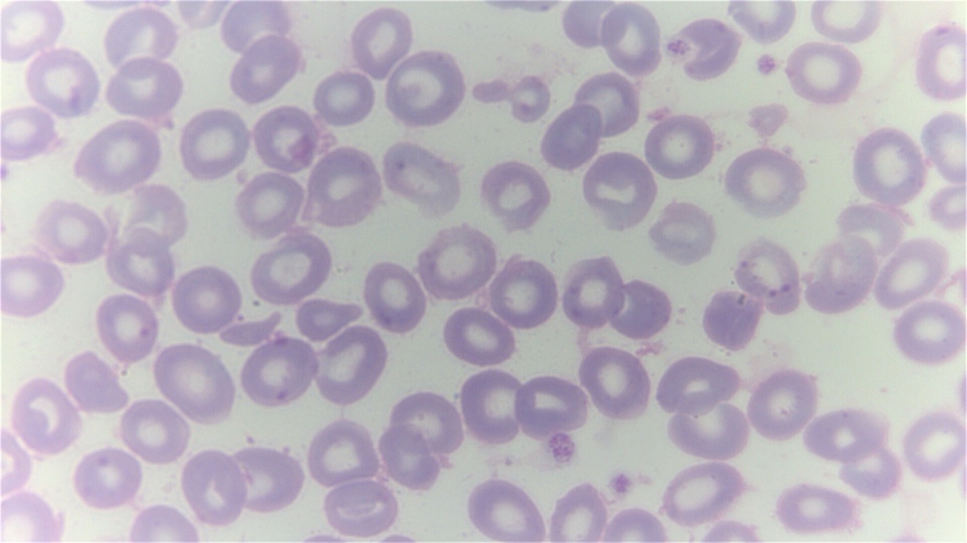A giemsa stained blood smear from a person with beta thalassemia