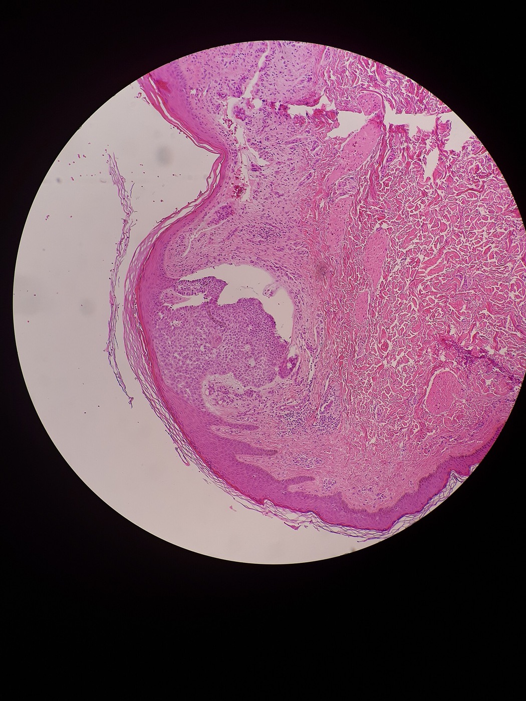 Micrograph of a nodular basal cell cancer with a cleft. H&E stain. Such clefts are caused by shrinkage of mucin during tissue fixation and staining. Robert S Bader. Which histologi