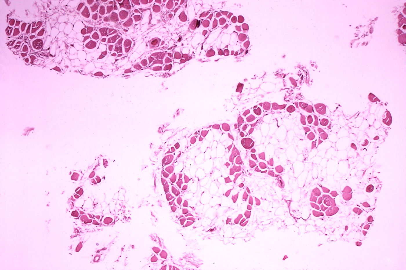 Histopathology of gastrocnemius muscle from patient who died of pseudohypertrophic muscular dystrophy, Duchenne type. Cross section of muscle shows extensive replacement of muscle 