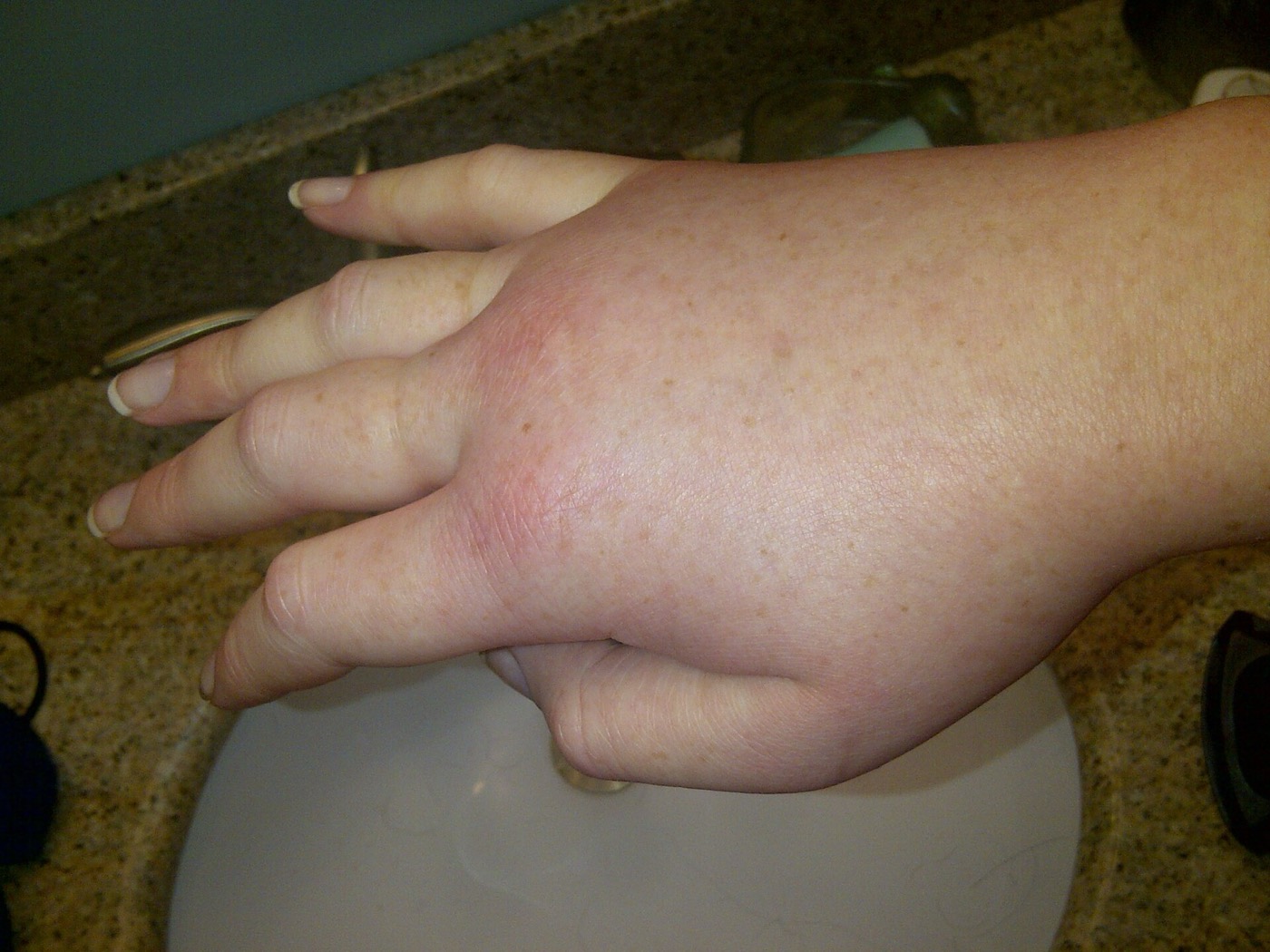 Swollen right hand in a female patient during a hereditary angioedema attack. Hereditary angioedema