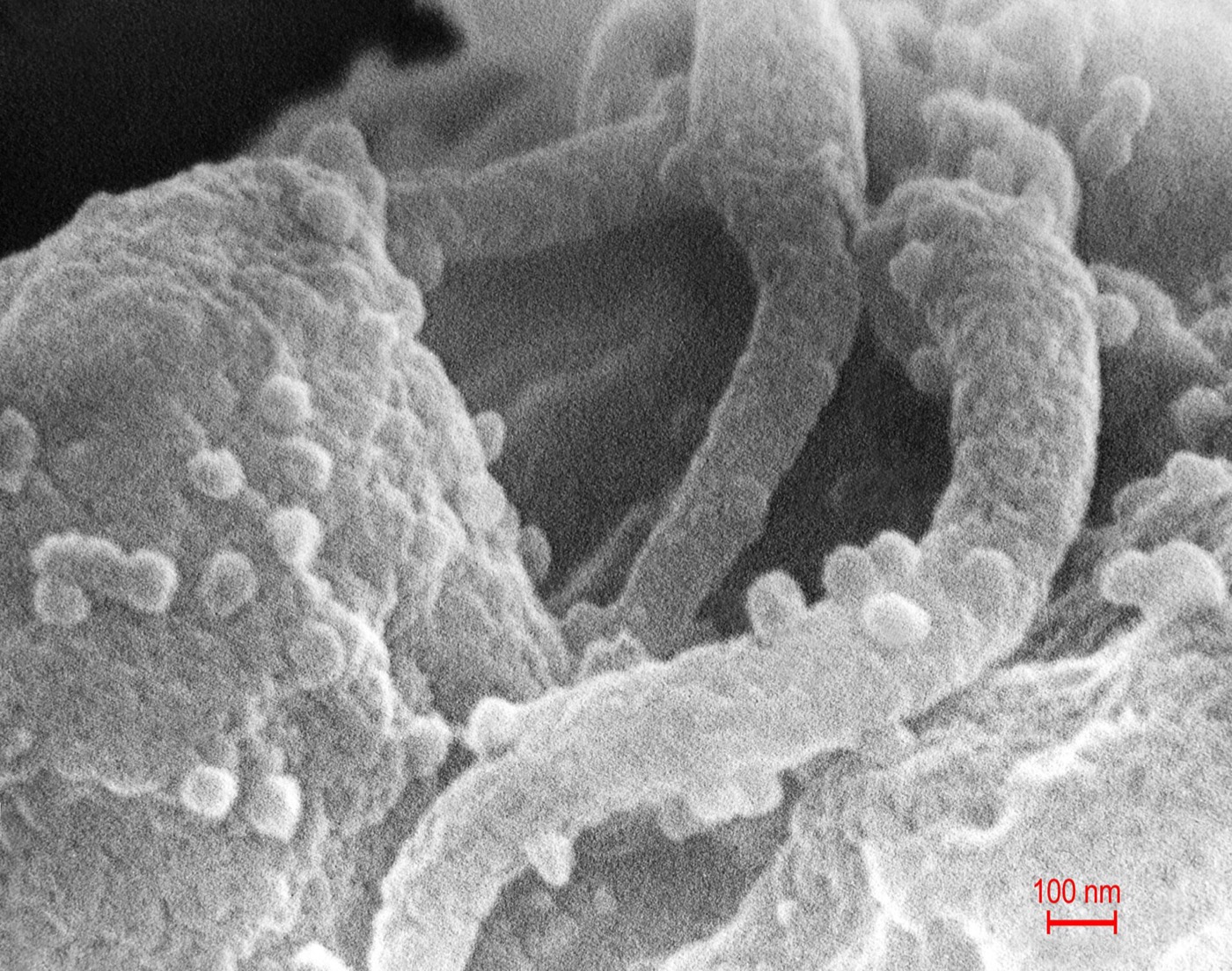 This scanning electron micrograph revealed the presence of the human immunodeficiency virus (HIV-1), (spherical in appearance), which had been co-cultivated with human lymphocytes.