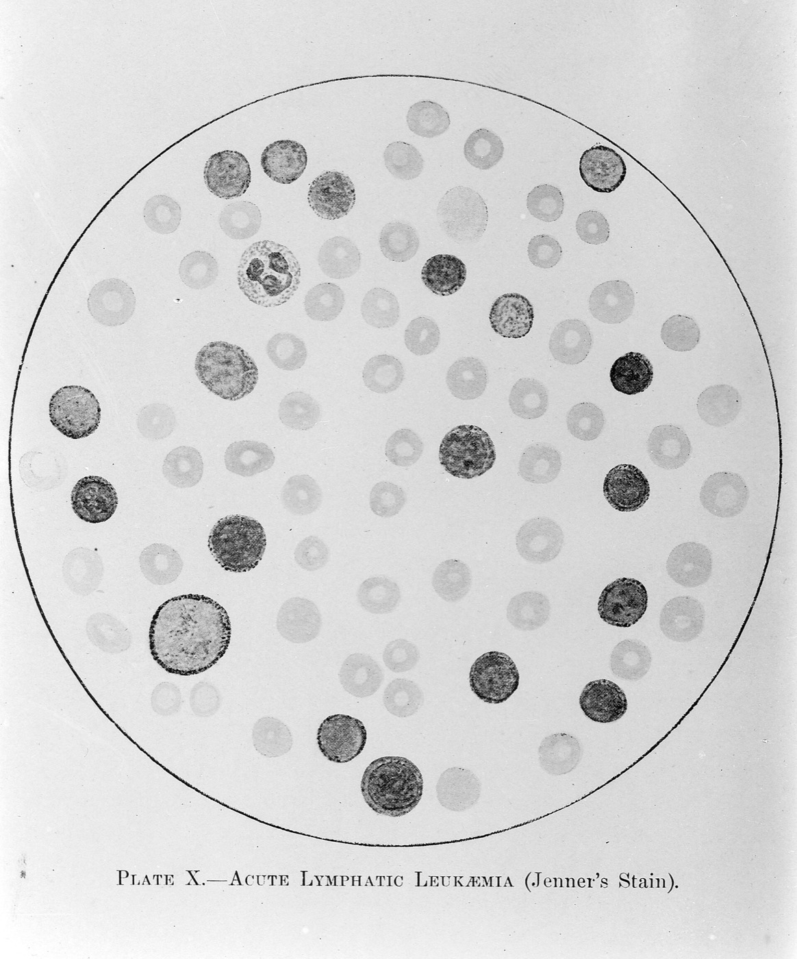 Blood smear showing acute lymphatic leukaemia (Jenner's stain). Wellcome Images Keywords: Clinical Medicine; Goodall; Haematology; Guilland; Leukaemia