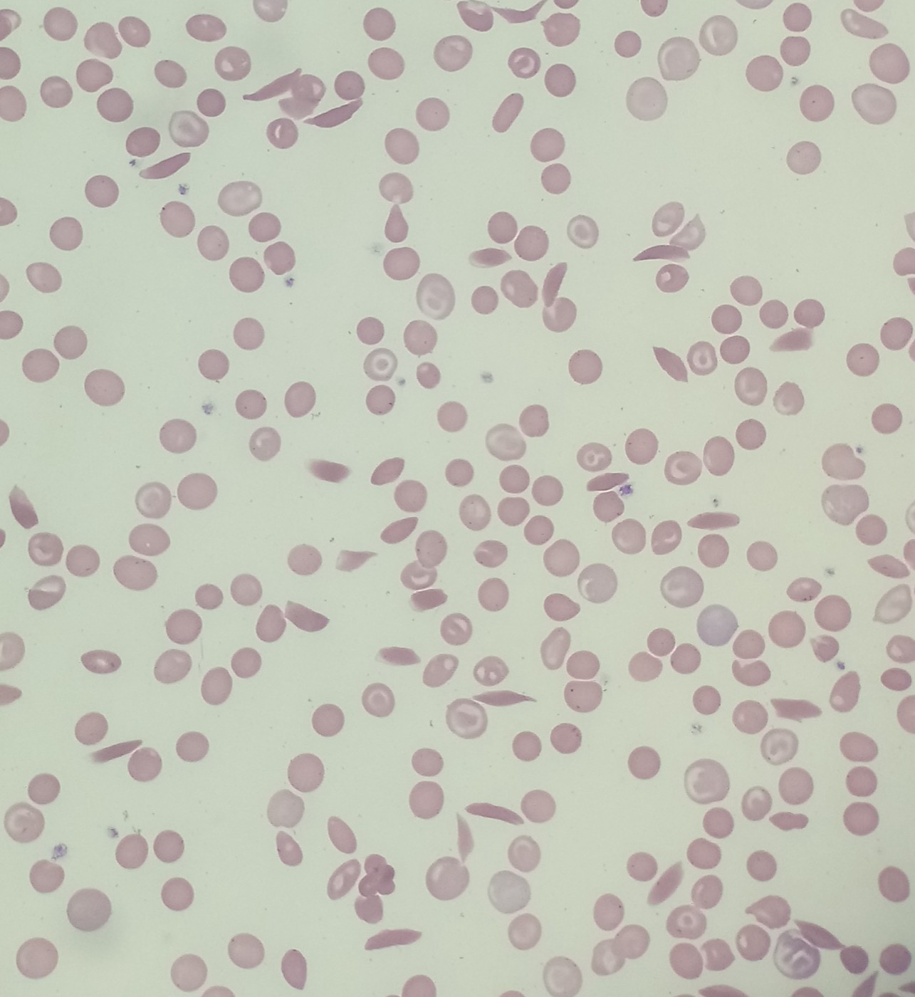 Blood smear from a patient with sickle cell anemia displaying sickle cells, polychromasia, and target cells